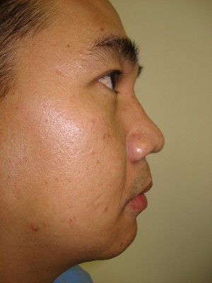 Before-Nose and Chin
