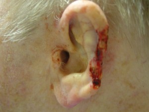 Before-Ear Reconstruction