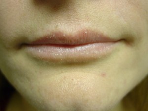 Before-Lip Augmentation