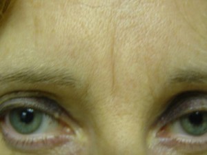 After-Glabella