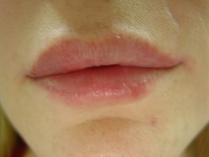 After-Lip Augmentation