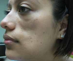 Before-Filler For Lupus