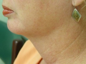 After-Neck Liposuction