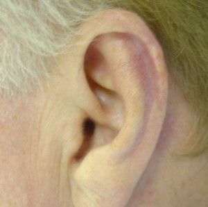 After-Ear Reconstruction