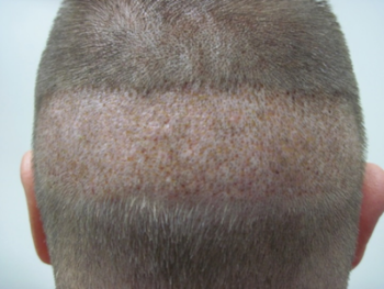 SmartGraft® Hair Restoration Before and After Pictures San Ramon, CA