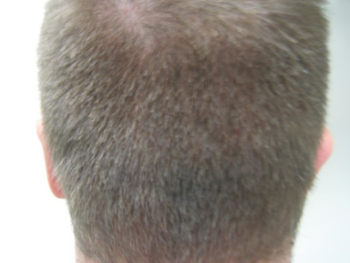 SmartGraft® Hair Restoration Before and After Pictures San Ramon, CA