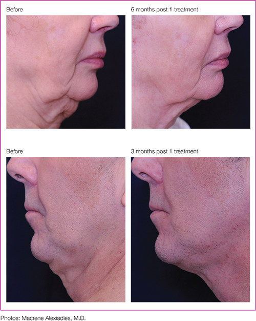 Profound® Skin Tightening Before and After Pictures San Ramon, CA