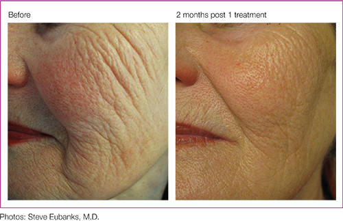 Profound® Skin Tightening Before and After Pictures San Ramon, CA