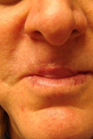 After-Lip Reconstruction