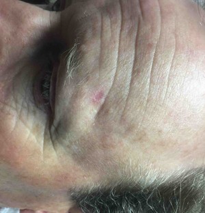 After-Forehead Reconstruction