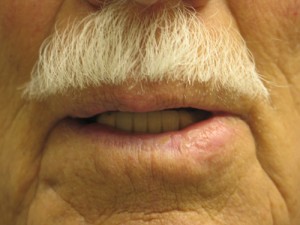 After-Lip Reconstruction