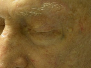 After-Eyelid Reconstruction