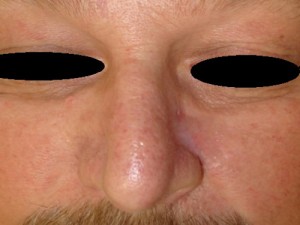 After-Nose Reconstruction