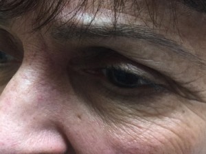 After-Eyelid Reconstruction