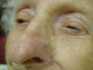After-Nose Reconstruction