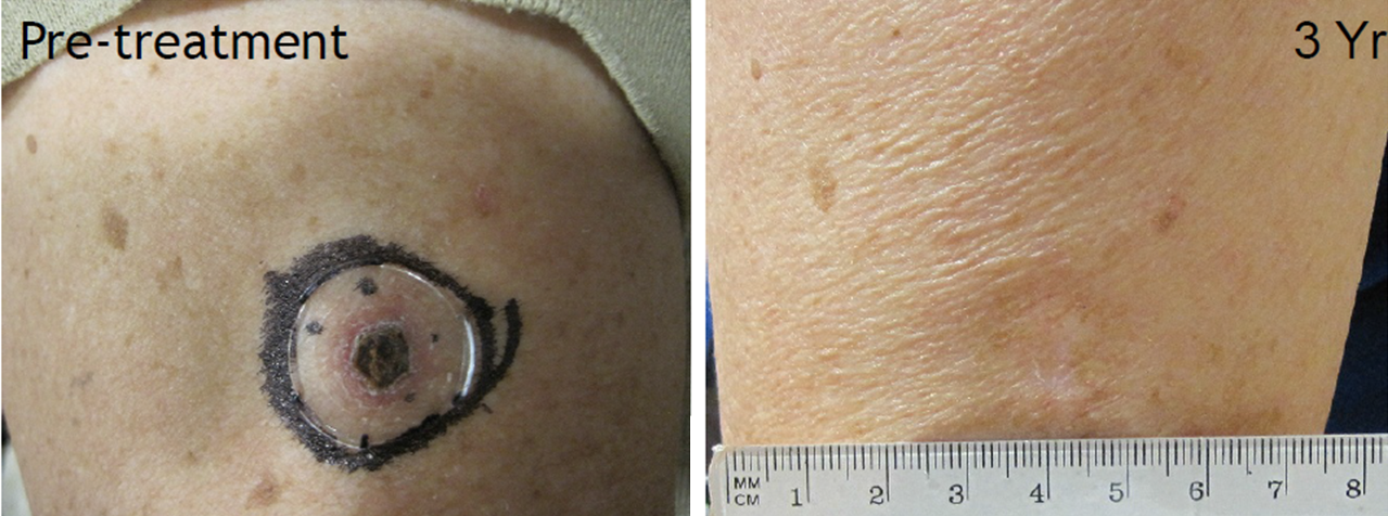 Electronic Brachytherapy Before and After Pictures San Ramon, CA