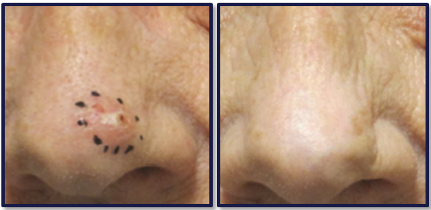 Electronic Brachytherapy Before and After Pictures San Ramon, CA