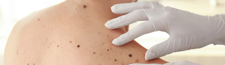Treatment of Moles - Dermatology Clinic in San Ramon and Manteca, CA
