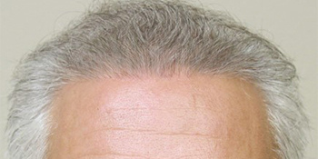 After-Hair Restoration