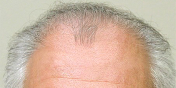 Before-Hair Restoration