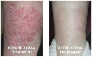 Before and After Prosiasis Treatment in San Ramon California