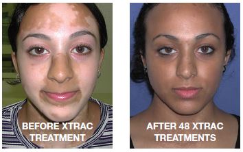 Vitiligo Before and After Treatment in San Ramon