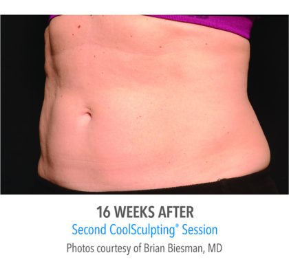 Coolsculpting Before & After Patient #334