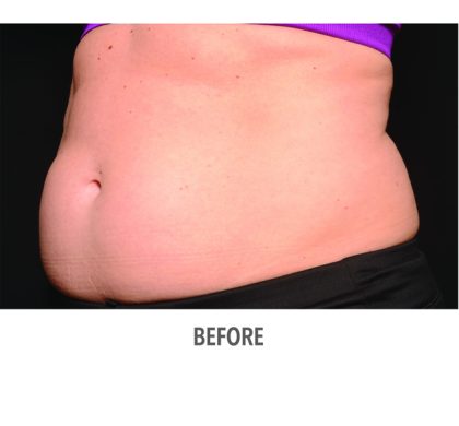 Coolsculpting Before & After Patient #334