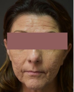 Mini Face Lift Before & After Patient #138