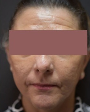 Mini Face Lift Before & After Patient #138