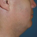 Neck Liposuction Before & After Patient #148