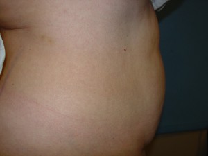 Liposuction Before & After Patient #304