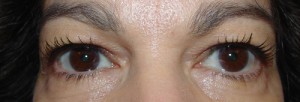 Upper Blepharoplasty Before & After Patient #66