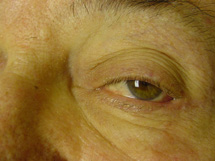 Eyelid Reconstruction Before & After Patient #189