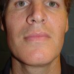 Neck Liposuction Before & After Patient #148