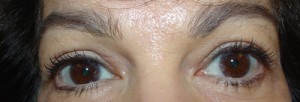 Upper Blepharoplasty Before & After Patient #66