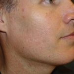 Neck Liposuction Before & After Patient #148