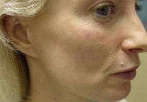 Fat Transfer Before & After Patient #338