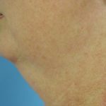 Neck Liposuction Before & After Patient #150