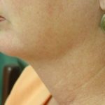 Neck Liposuction Before & After Patient #150
