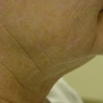 Neck Liposuction Before & After Patient #151