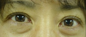 Lower Blepharoplasty Before & After Patient #79