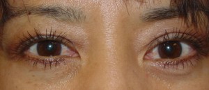 Lower Blepharoplasty Before & After Patient #79