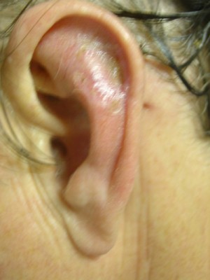 Ear Reconstruction Before & After Patient #176