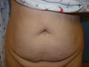 Liposuction Before & After Patient #288