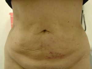 Liposuction Before & After Patient #288