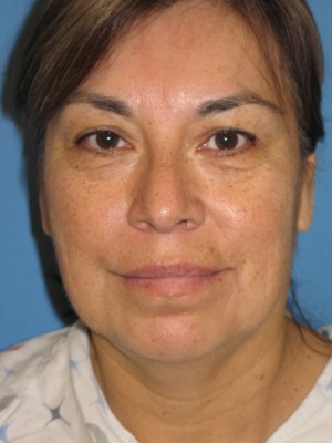 Facelift Before & After Patient #113