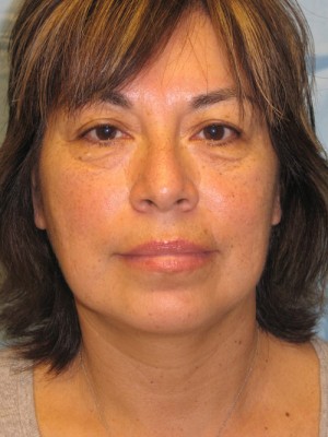 Facelift Before & After Patient #113