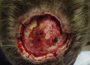 Scalp Reconstruction Before & After Patient #229