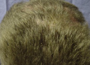 Scalp Reconstruction Before & After Patient #229